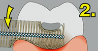 Методика чистки зубов ершиком для межзубных промежутков