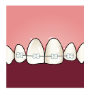 Укрепление зубов шинирующей лентой