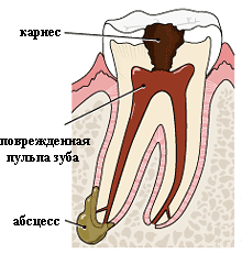 Зуб с поврежденной пульпой