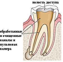 Шаг 2. Вскрытие коронки зуба
