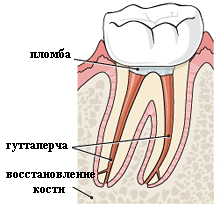 Шаг 4. Восстановление коронки зуба