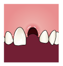 Выбитый зуб. Раневая лунка