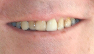 Поврежденные зубы перед установкой виниров