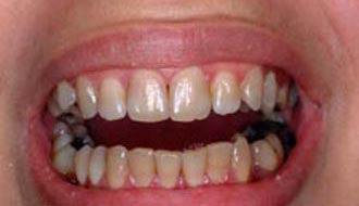 Поврежденные зубы перед установкой виниров