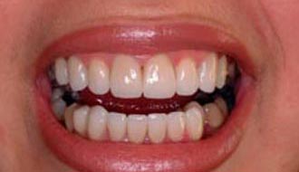 Зубные виниры: красивая улыбка после установки