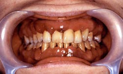 Зубы, пораженные пародонтозом