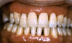 Зубы после лечения пародонтоза
