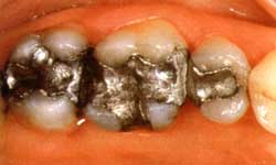 Лечение кариеса. Зубы до реставрации