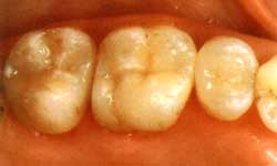 Лечение кариеса. Зубы после реставрации
