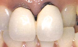 Зубы до реставрации цельнокерамическими коронками