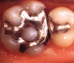 Лечение кариеса. До реставрации зуба