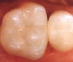 Лечение кариеса. После реставрации зуба
