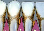 Зубы с заболеванием пародонтита тяжелой степени