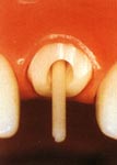 Восстановление коронковой части зуба. Зуб до реставрации
