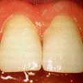 Несъемное протезирование - установка виниров для зубов с пломбами в пришеечной области