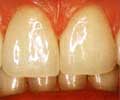 Несъемное протезирование - Виниры. Зубы после реставрации