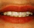 Несъемное протезирование. Зубы с большими дефектами эмали после реставрации