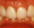 Несъемное протезирование зубов для коррекции положения зубов