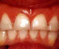 Несъемное зубное протезирование