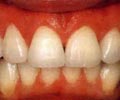 Несъемное протезирование зубов с помощью виниров