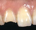 Перелом зуба (скол эмали) до установки винира