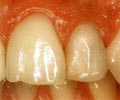 Зубы до установки внира - депульпированный зуб