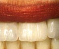 Несъемное протезирование - зубы до установки винира