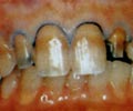 Несъемное протезирование. Зубы с выраженным дисколоритом