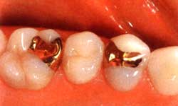 Лечение кариеса. 12-летние вкладки на зубах