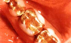 Лечение кариеса. 40-летние вставки на зубах